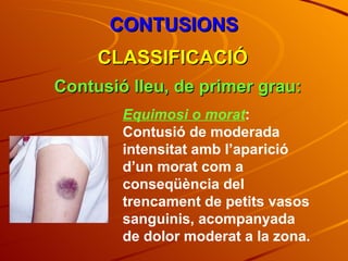 CONTUSIONS CLASSIFICACIÓ Contusió lleu, de primer grau: Equimosi o morat : Contusió de moderada intensitat amb l’aparició d’un morat com a conseqüència del trencament de petits vasos sanguinis, acompanyada de dolor moderat a la zona. 