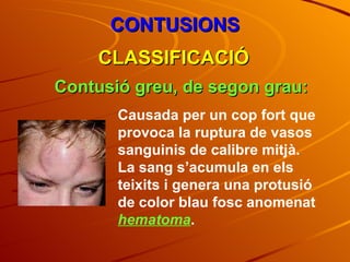 CONTUSIONS CLASSIFICACIÓ Contusió greu, de segon grau: Causada per un cop fort que provoca la ruptura de vasos sanguinis de calibre mitjà. La sang s’acumula en els teixits i genera una protusió de color blau fosc anomenat  hematoma . 