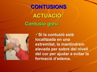 CONTUSIONS ACTUACIÓ: Contusió greu: Si la contusió està localitzada en una extremitat, la mantindrem elevada per sobre del nivell del cor per ajudar a evitar la formació d’edema. 
