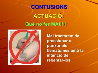 CONTUSIONS ACTUACIÓ: Què no fer MAI!!!: Mai tractarem de pressionar o punxar els hematomes amb la intenció de rebentar-los. 