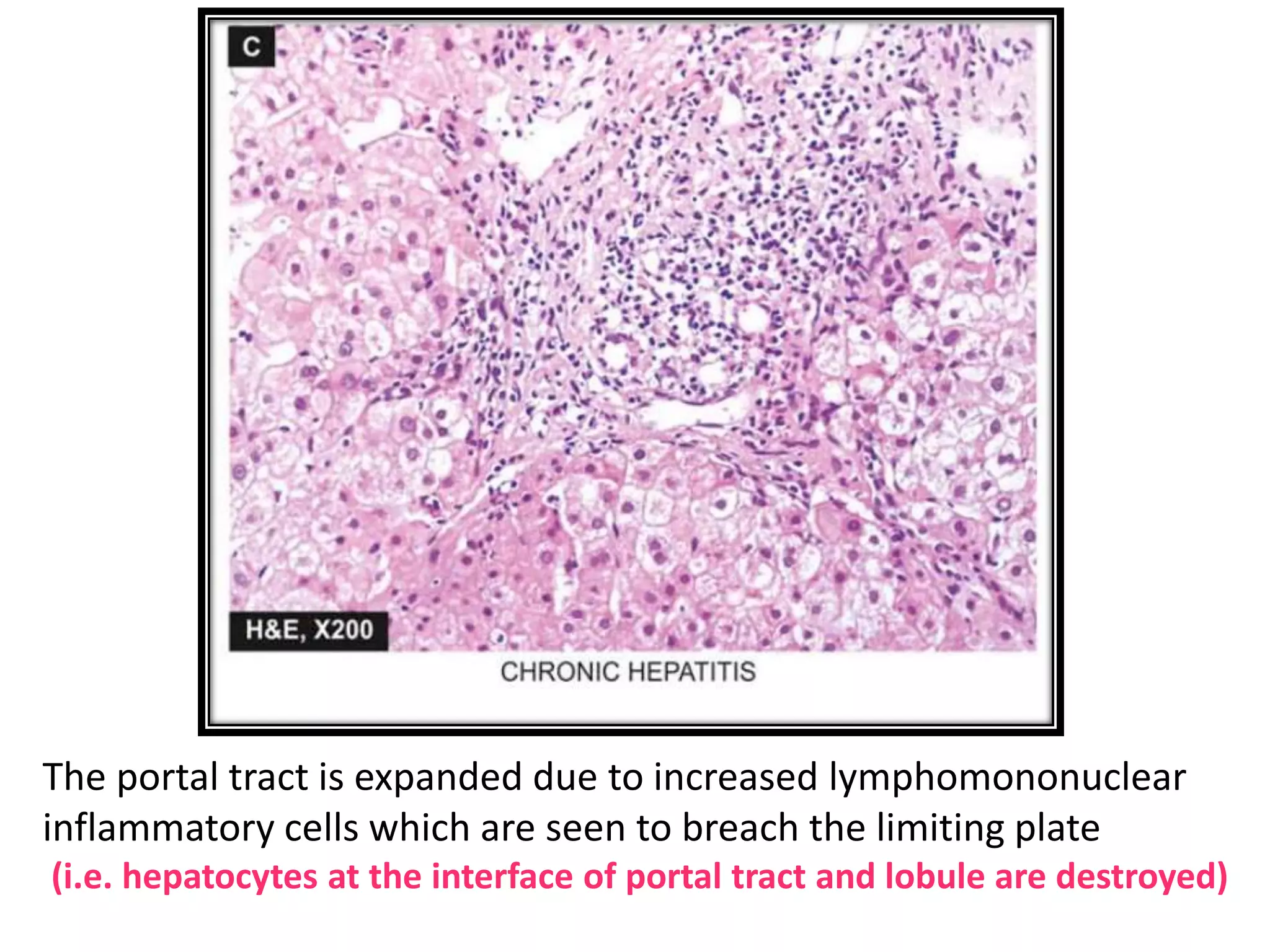 THE LIVER: ACUTE & CHRONIC HEPATITIS | PPTX