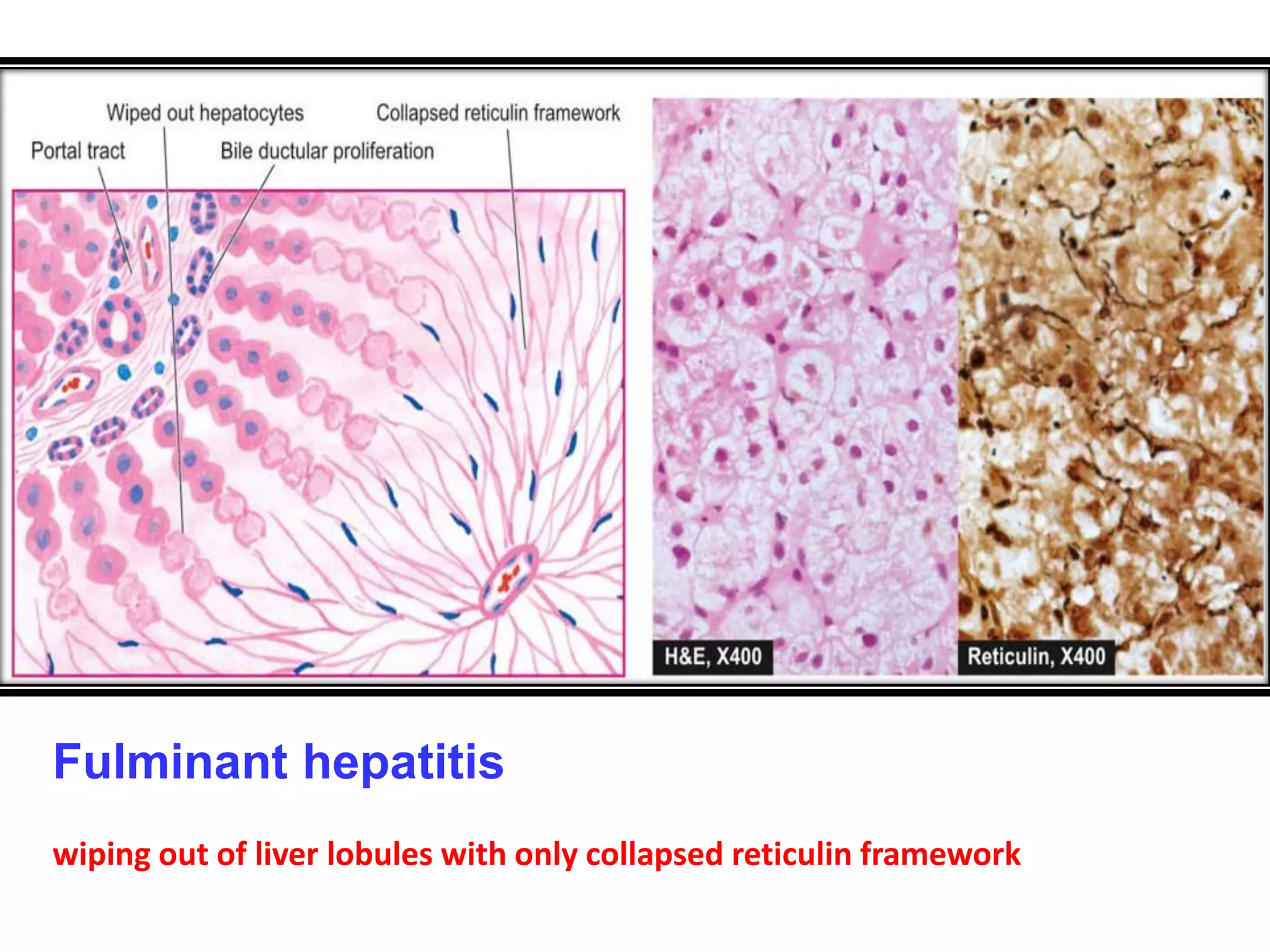 THE LIVER: ACUTE & CHRONIC HEPATITIS | PPTX
