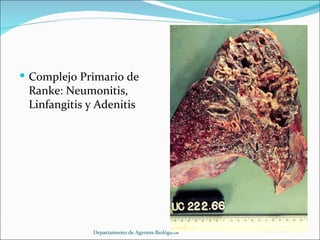 Complejo Primario de Ranke: Neumonitis, Linfangitis y Adenitis Departamento de Agentes Biológicos 