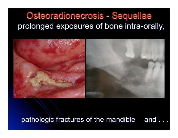 9.(new)osteoradionecrosis