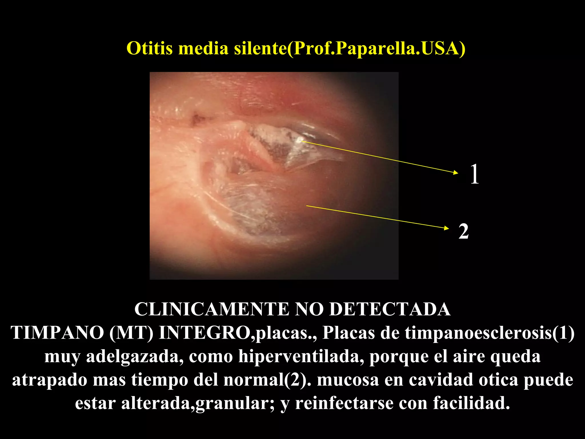 Otitis media silente(Prof.Paparella.USA)




                                                        1
                                                    2


               CLINICAMENTE NO DETECTADA
TIMPANO (MT) INTEGRO,placas., Placas de timpanoesclerosis(1)
    muy adelgazada, como hiperventilada, porque el aire queda
atrapado mas tiempo del normal(2). mucosa en cavidad otica puede
       estar alterada,granular; y reinfectarse con facilidad.
 