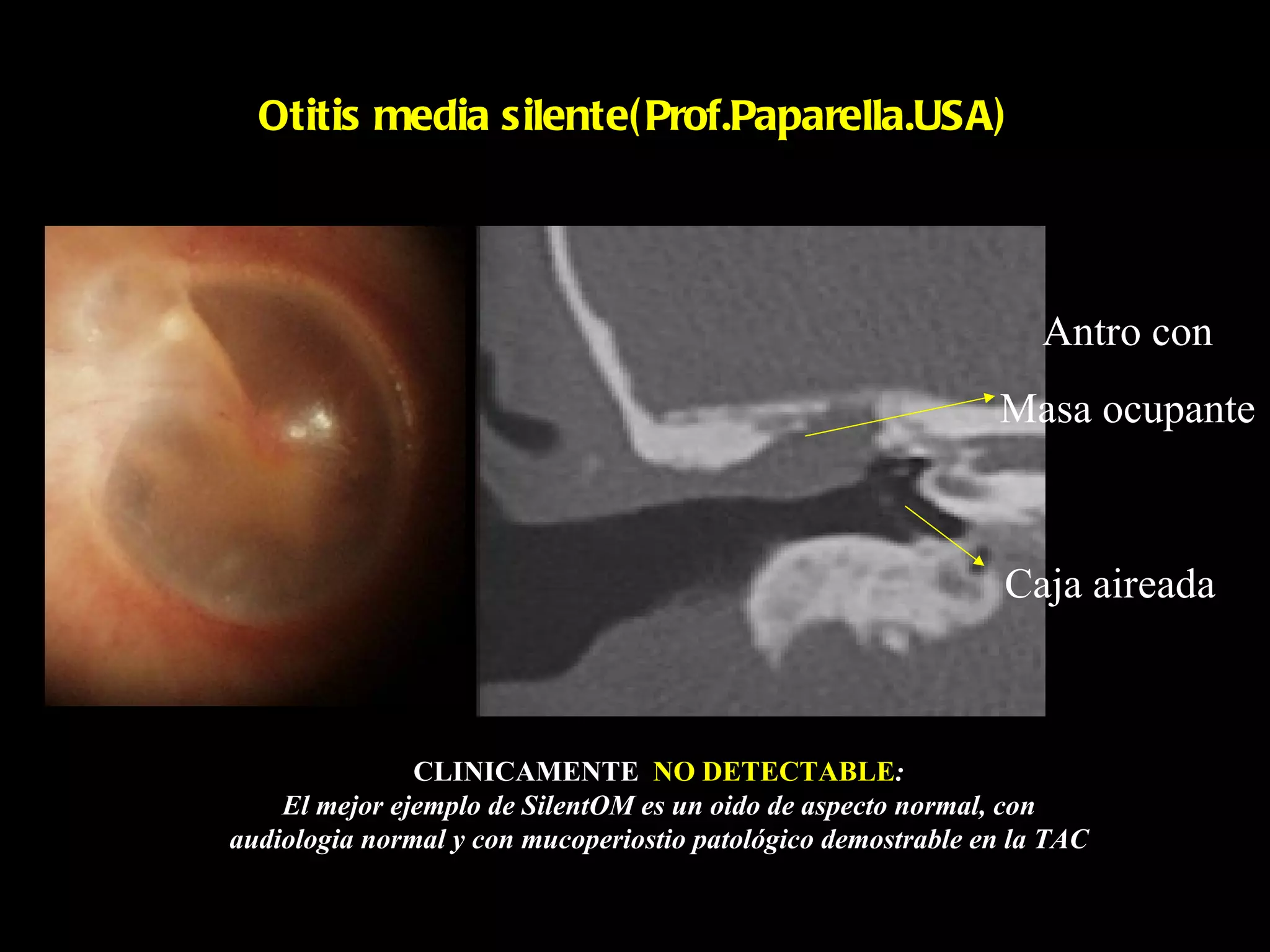 Otitis media silente( Prof.Paparella.USA)




                                                                  Antro con
                                                              Masa ocupante



                                                               Caja aireada



               CLINICAMENTE NO DETECTABLE:
    El mejor ejemplo de SilentOM es un oido de aspecto normal, con
audiologia normal y con mucoperiostio patológico demostrable en la TAC
 