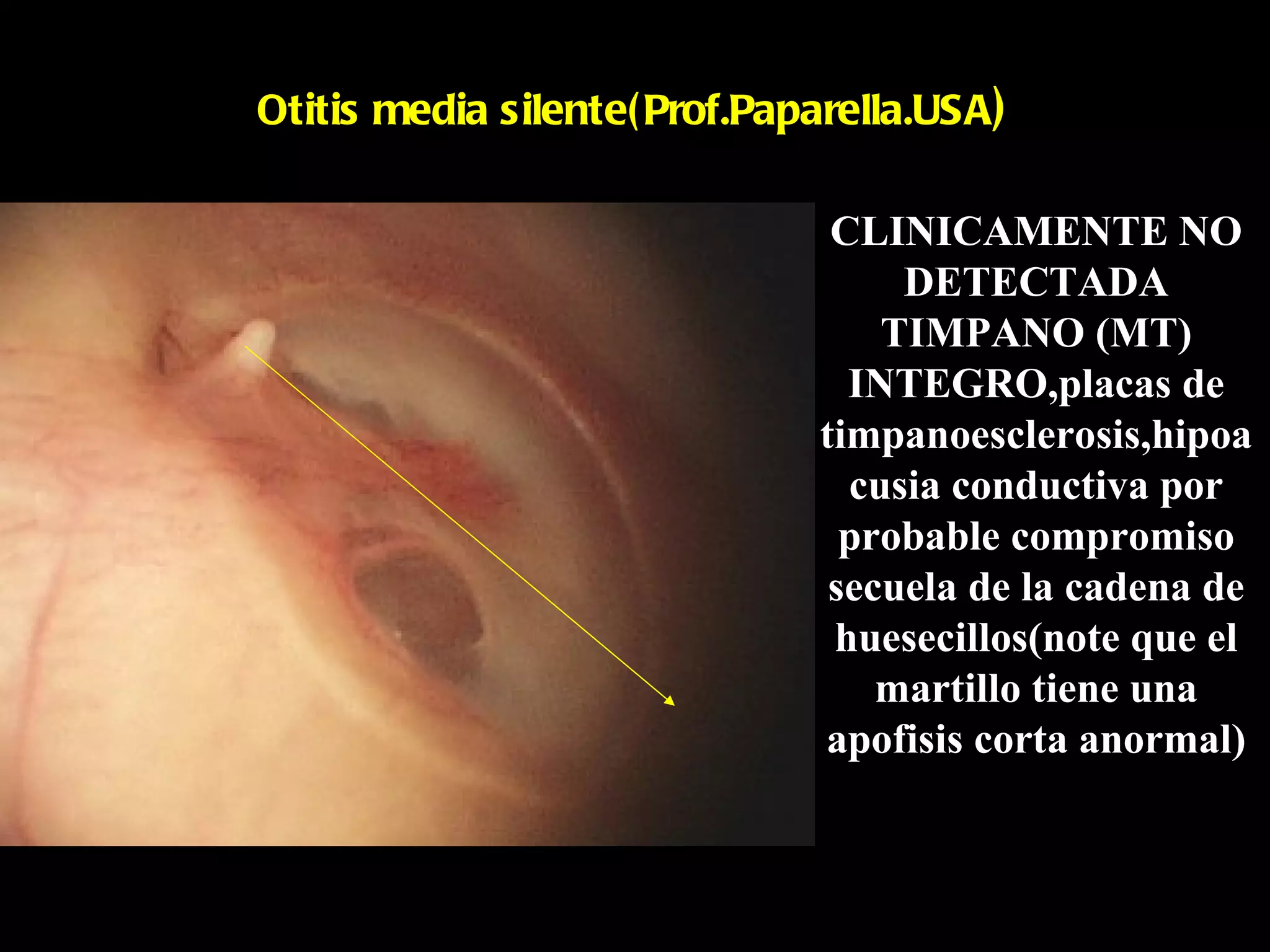 Otitis media silente( Prof.Paparella.USA )

                                CLINICAMENTE NO
                                    DETECTADA
                                   TIMPANO (MT)
                                 INTEGRO,placas de
                               timpanoesclerosis,hipoa
                                 cusia conductiva por
                                 probable compromiso
                                secuela de la cadena de
                                huesecillos(note que el
                                   martillo tiene una
                               apofisis corta anormal)
 