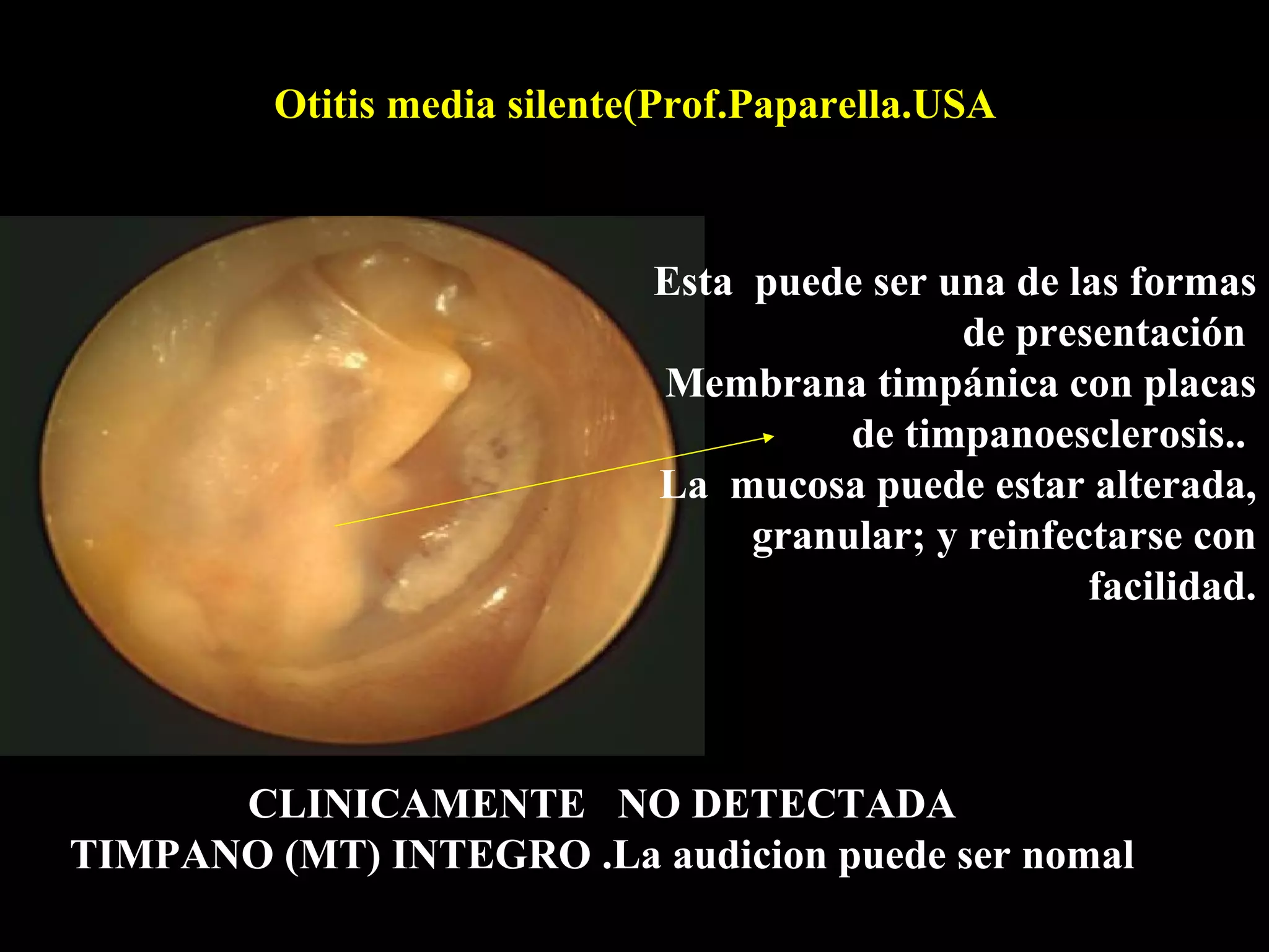 Otitis media silente(Prof.Paparella.USA



                             Esta puede ser una de las formas
                                             de presentación
                             Membrana timpánica con placas
                                       de timpanoesclerosis..
                             La mucosa puede estar alterada,
                                  granular; y reinfectarse con
                                                     facilidad.




      CLINICAMENTE NO DETECTADA
TIMPANO (MT) INTEGRO .La audicion puede ser nomal
 