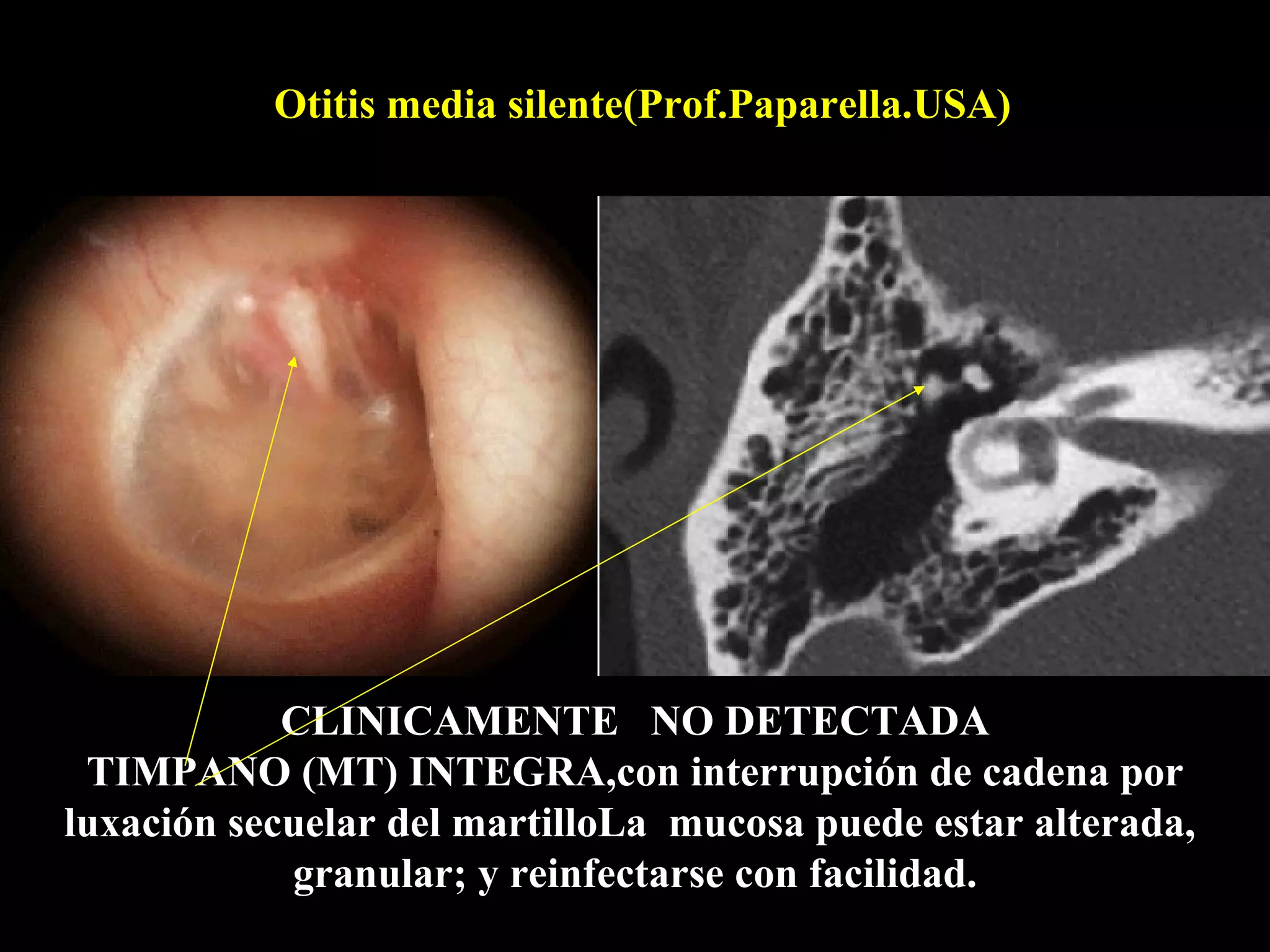 Otitis media silente(Prof.Paparella.USA)




            CLINICAMENTE NO DETECTADA
 TIMPANO (MT) INTEGRA,con interrupción de cadena por
luxación secuelar del martilloLa mucosa puede estar alterada,
            granular; y reinfectarse con facilidad.
 