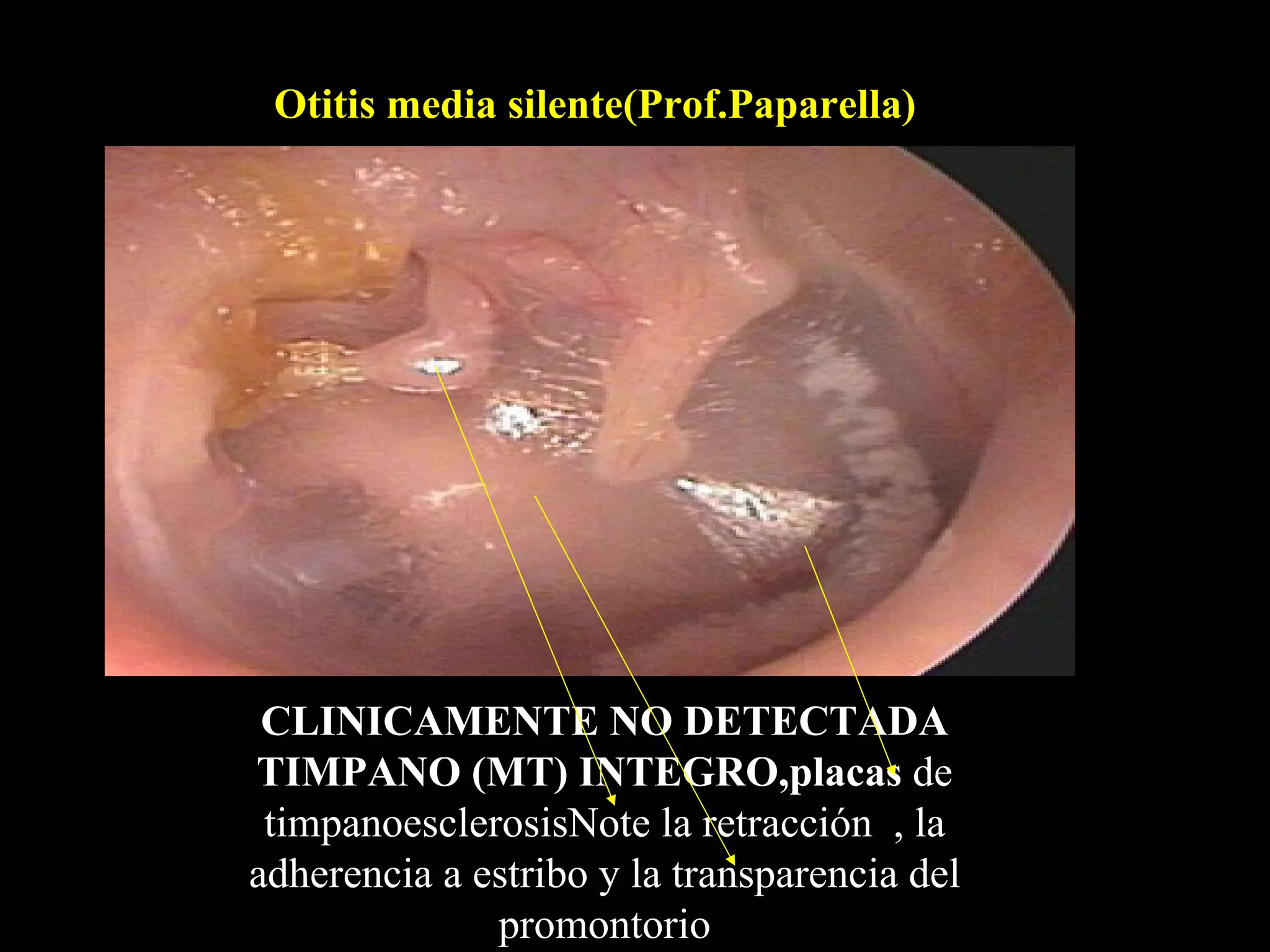 Otitis media silente(Prof.Paparella)




 CLINICAMENTE NO DETECTADA
TIMPANO (MT) INTEGRO,placas de
 timpanoesclerosisNote la retracción , la
adherencia a estribo y la transparencia del
              promontorio
 