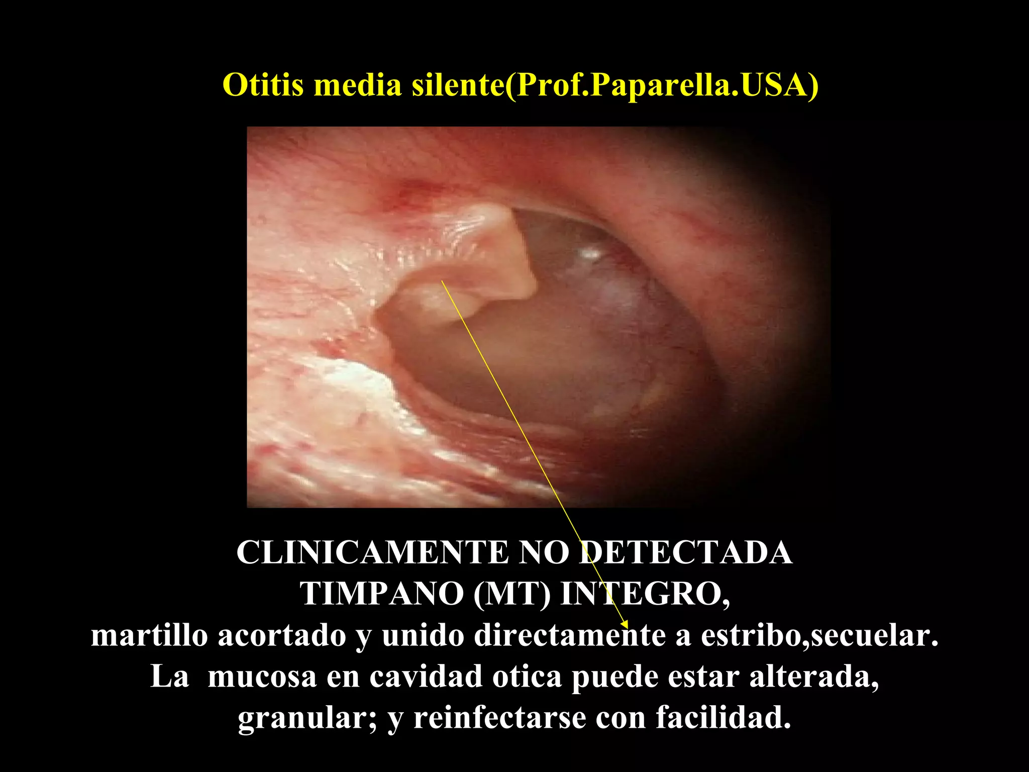 Otitis media silente(Prof.Paparella.USA)




          CLINICAMENTE NO DETECTADA
              TIMPANO (MT) INTEGRO,
martillo acortado y unido directamente a estribo,secuelar.
   La mucosa en cavidad otica puede estar alterada,
          granular; y reinfectarse con facilidad.
 