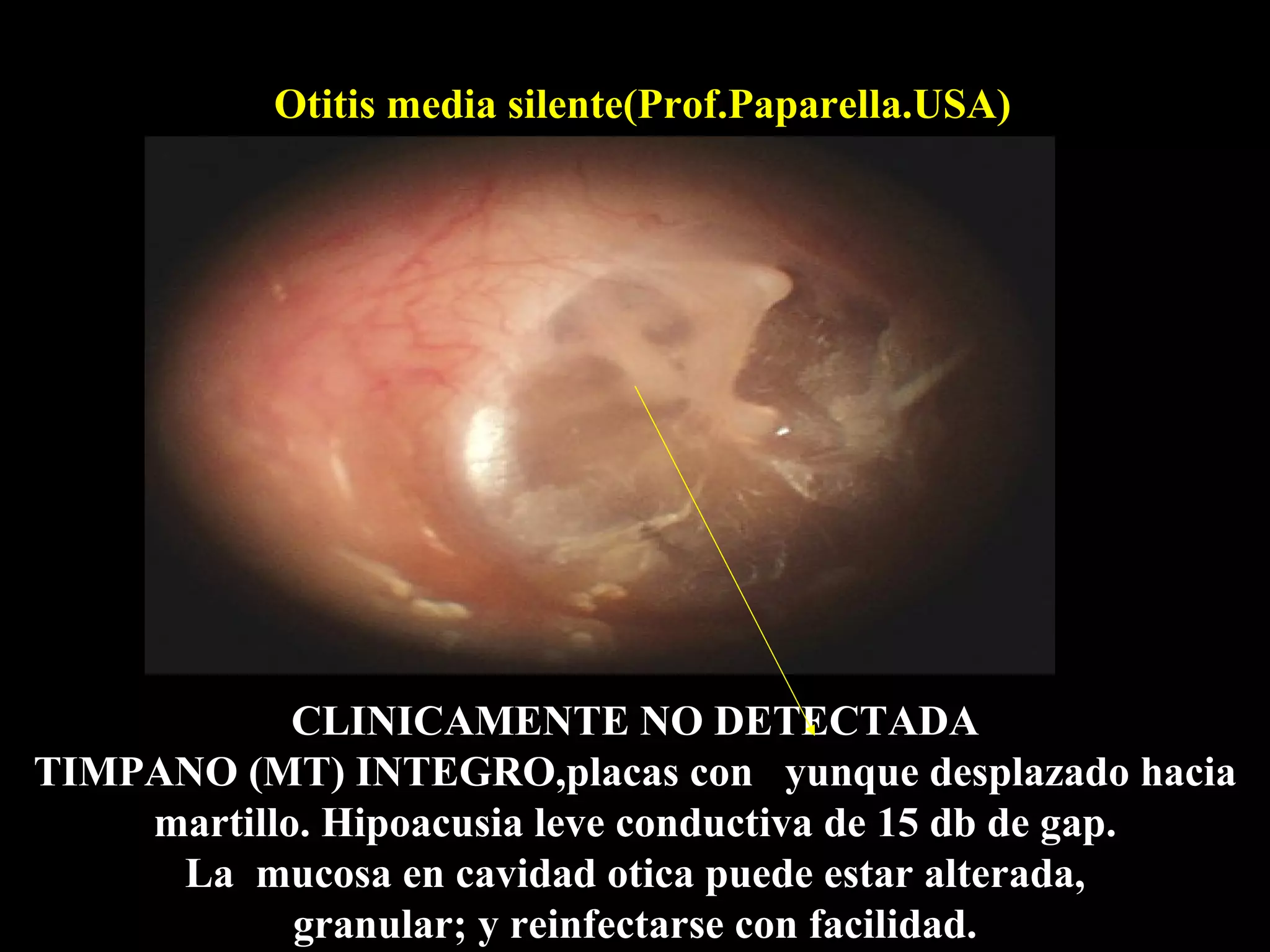 Otitis media silente(Prof.Paparella.USA)




            CLINICAMENTE NO DETECTADA
TIMPANO (MT) INTEGRO,placas con yunque desplazado hacia
    martillo. Hipoacusia leve conductiva de 15 db de gap.
     La mucosa en cavidad otica puede estar alterada,
            granular; y reinfectarse con facilidad.
 