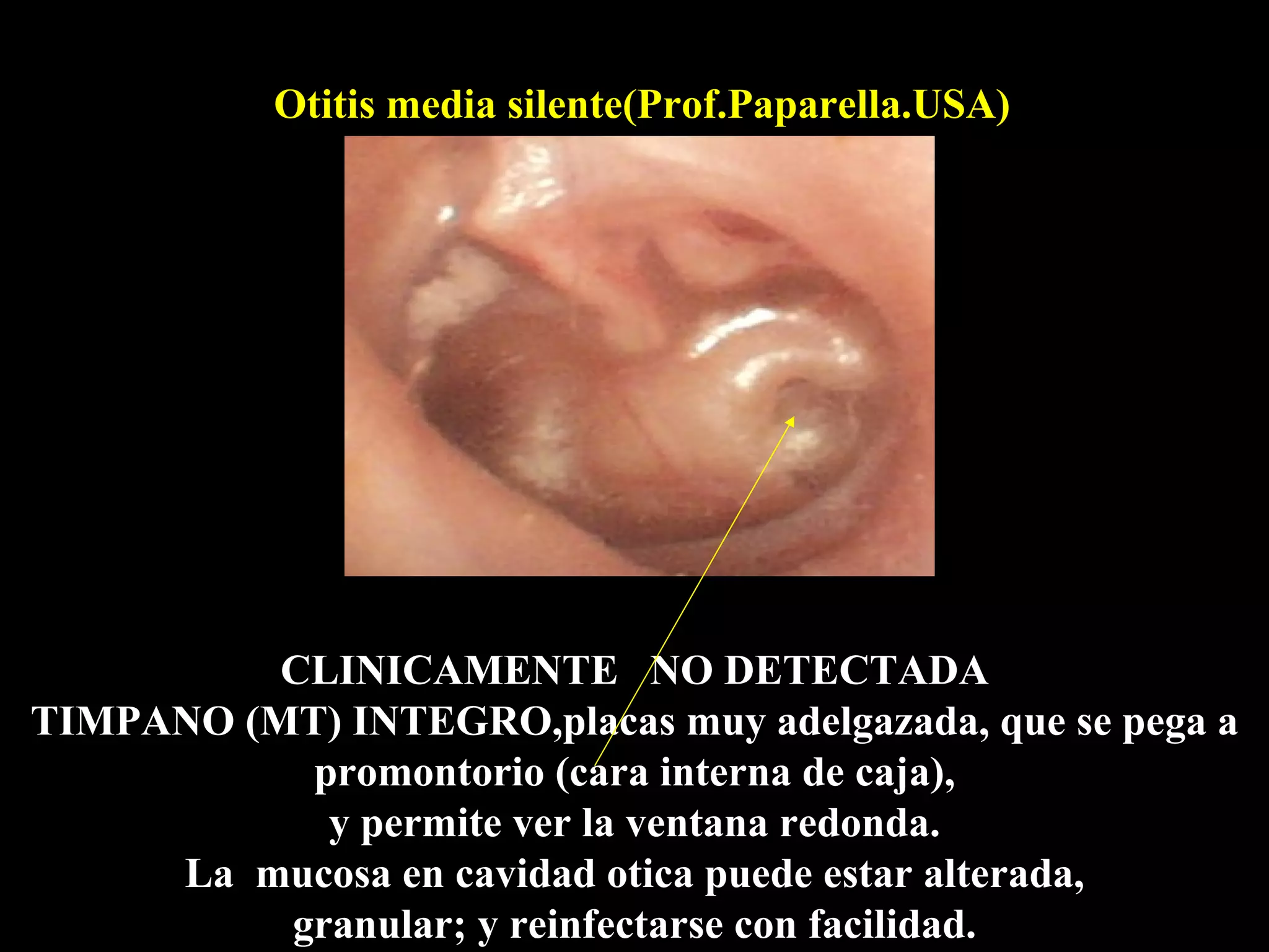 Otitis media silente(Prof.Paparella.USA)




          CLINICAMENTE NO DETECTADA
TIMPANO (MT) INTEGRO,placas muy adelgazada, que se pega a
           promontorio (cara interna de caja),
            y permite ver la ventana redonda.
     La mucosa en cavidad otica puede estar alterada,
          granular; y reinfectarse con facilidad.
 