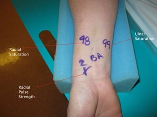 Radial
Saturation
Ulnar
Saturation
Radial
Pulse
Strength
 