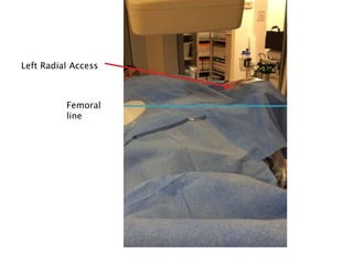 Left Radial Access
Femoral
line
 