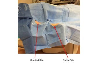 Brachial Site Radial Site
 