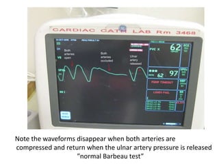 Note the waveforms disappear when both arteries are
compressed and return when the ulnar artery pressure is released
”normal Barbeau test”
Both
arteries
open
Both
arteries
occluded
Ulnar
artery
released
 