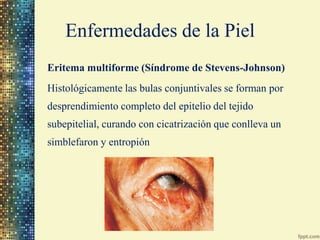Enfermedades de la Piel
Eritema multiforme (Síndrome de Stevens-Johnson)

• Frecuentemente las células caliciformes y aper...
