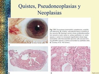 Quistes, Pseudoneoplasias y
         Neoplasias
 