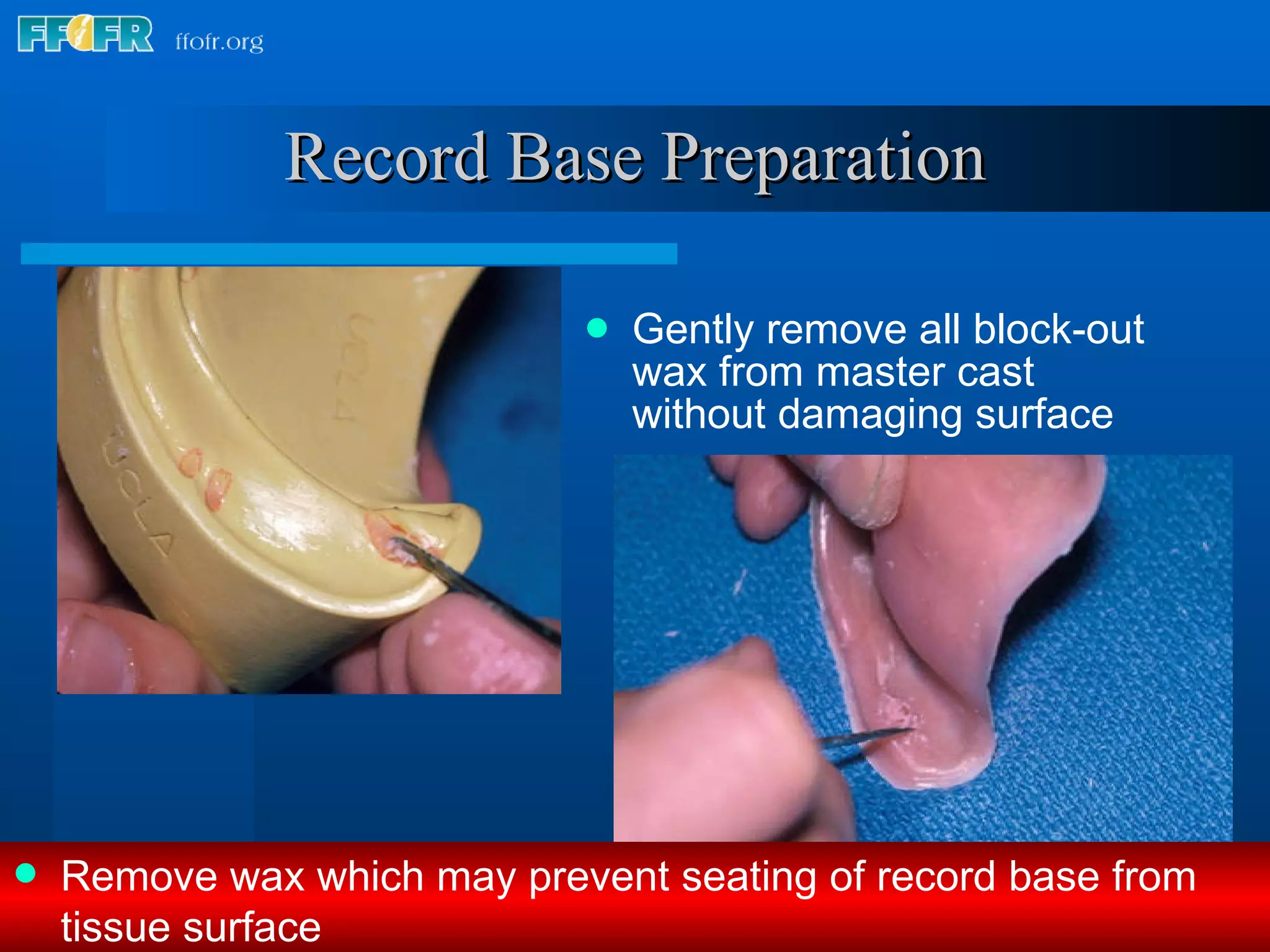Wax Rim Model 9.record base and wax rim fabrication | PPT