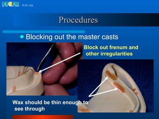 Procedures   Blocking out the master casts Block out frenum and other irregularities Wax should be thin enough to see through 