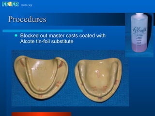 Procedures   Blocked out master casts coated with Alcote tin-foil substitute 