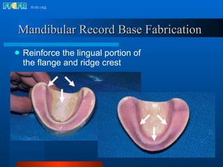 Mandibular Record Base Fabrication   Reinforce the lingual portion of the flange and ridge crest 