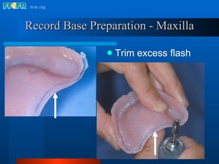 Record Base Preparation - Maxilla Trim excess flash 
