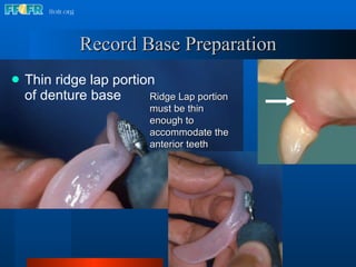 Record Base Preparation Thin ridge lap portion of denture base Ridge Lap portion  must be thin enough to accommodate the anterior teeth 