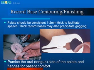 Record Base Contouring/Finishing Palate should be consistent 1-2mm thick to facilitate speech. Thick record bases may also precipitate gagging. Pumice the oral (tongue) side of the palate and flanges for patient comfort 