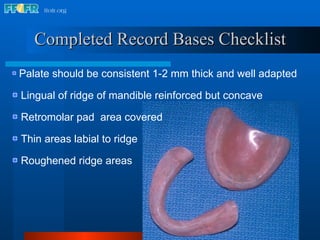 Completed Record Bases Checklist Palate should be consistent 1-2 mm thick and well adapted Lingual of ridge of mandible reinforced but concave Retromolar pad  area covered Thin areas labial to ridge Roughened ridge areas 