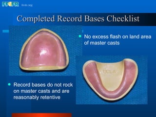 Completed Record Bases Checklist No excess flash on land area of master casts Record bases do not rock on master casts and are reasonably retentive 
