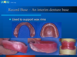 Record Base – An interim denture base Used to support wax rims 