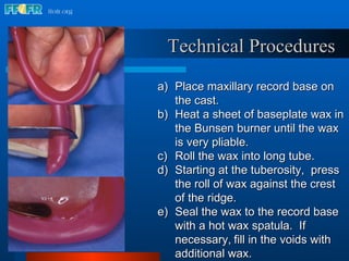 Place maxillary record base on the cast. Heat a sheet of baseplate wax in the Bunsen burner until the wax is very pliable. Roll the wax into long tube. Starting at the tuberosity,  press the roll of wax against the crest of the ridge. Seal the wax to the record base with a hot wax spatula.  If necessary,   fill in the voids with additional wax. Technical Procedures 