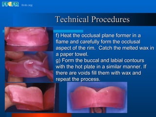 f) Heat the occlusal plane former in a flame and carefully form the occlusal aspect of the rim.  Catch the melted wax in a paper towel. g) Form the buccal and labial contours with the hot plate in a similar manner. If there are voids fill them with wax and repeat the process. Technical Procedures 