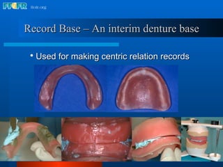 Record Base – An interim denture base Used for making centric relation records 