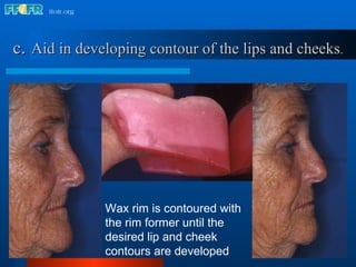 c .   Aid in developing contour of the lips and cheeks . Wax rim is contoured with the rim former until the desired lip and cheek contours are developed 