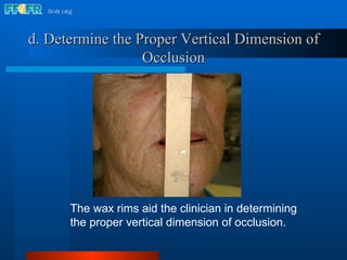 d. Determine the Proper Vertical Dimension of Occlusion The wax rims aid the clinician in determining the proper vertical dimension of occlusion. 