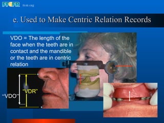e .   Used to Make Centric Relation Records “ VDR” “ VDO ”  VDO = The length of the face when the teeth are in contact and the mandible or the teeth are in centric relation 