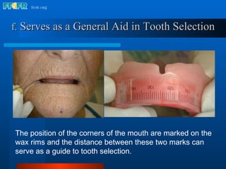 f.   Serves as a General Aid in Tooth Selection The position of the corners of the mouth are marked on the wax rims and the distance between these two marks can serve as a guide to tooth selection. 