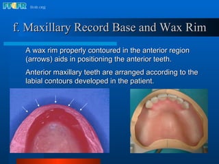 A wax rim properly contoured in the anterior region (arrows) aids in positioning the anterior teeth. Anterior maxillary teeth are arranged according to the labial contours developed in the patient. f. Maxillary Record Base and Wax Rim 