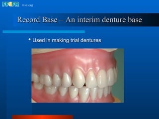 Record Base – An interim denture base Used in making trial dentures 