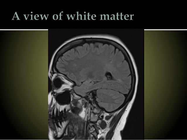 Devic's Disease
