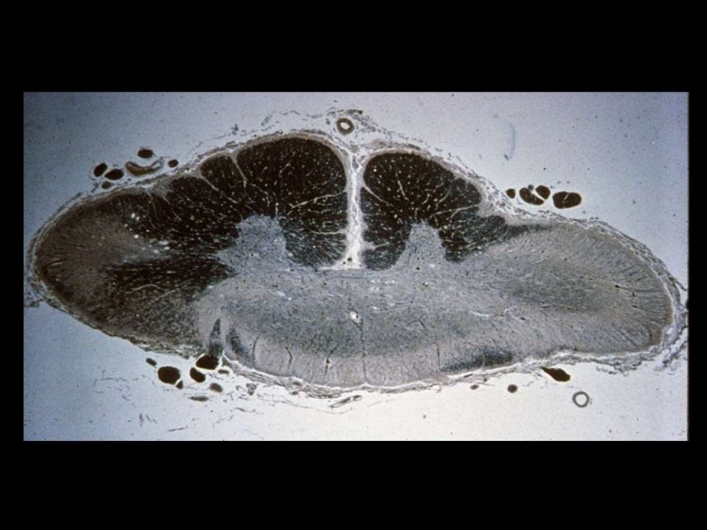 Devic's Disease