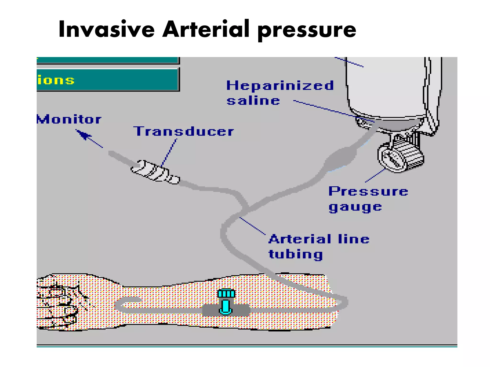 Invasive Arterial pressure
 