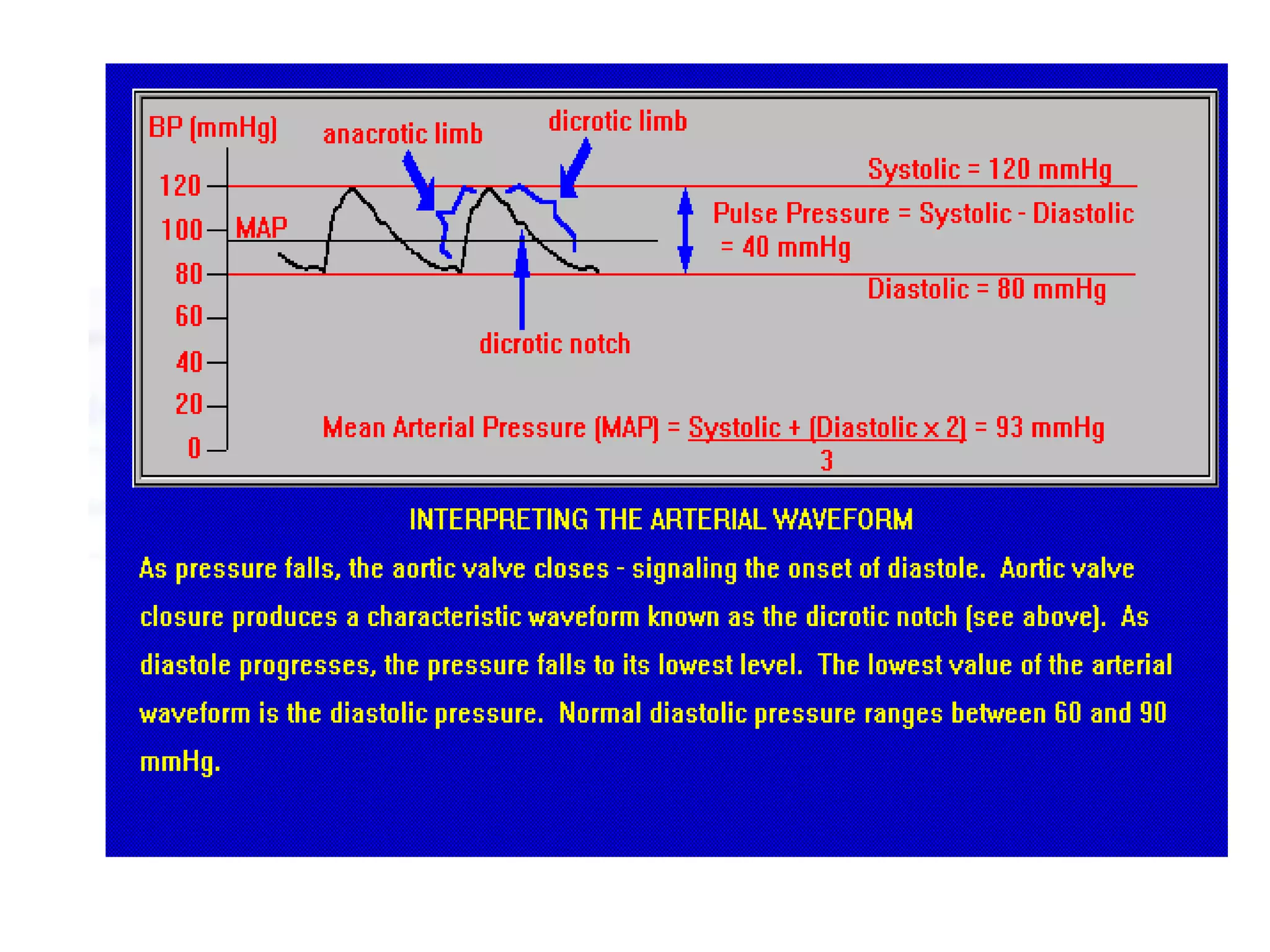 Normal arterial wave form
 