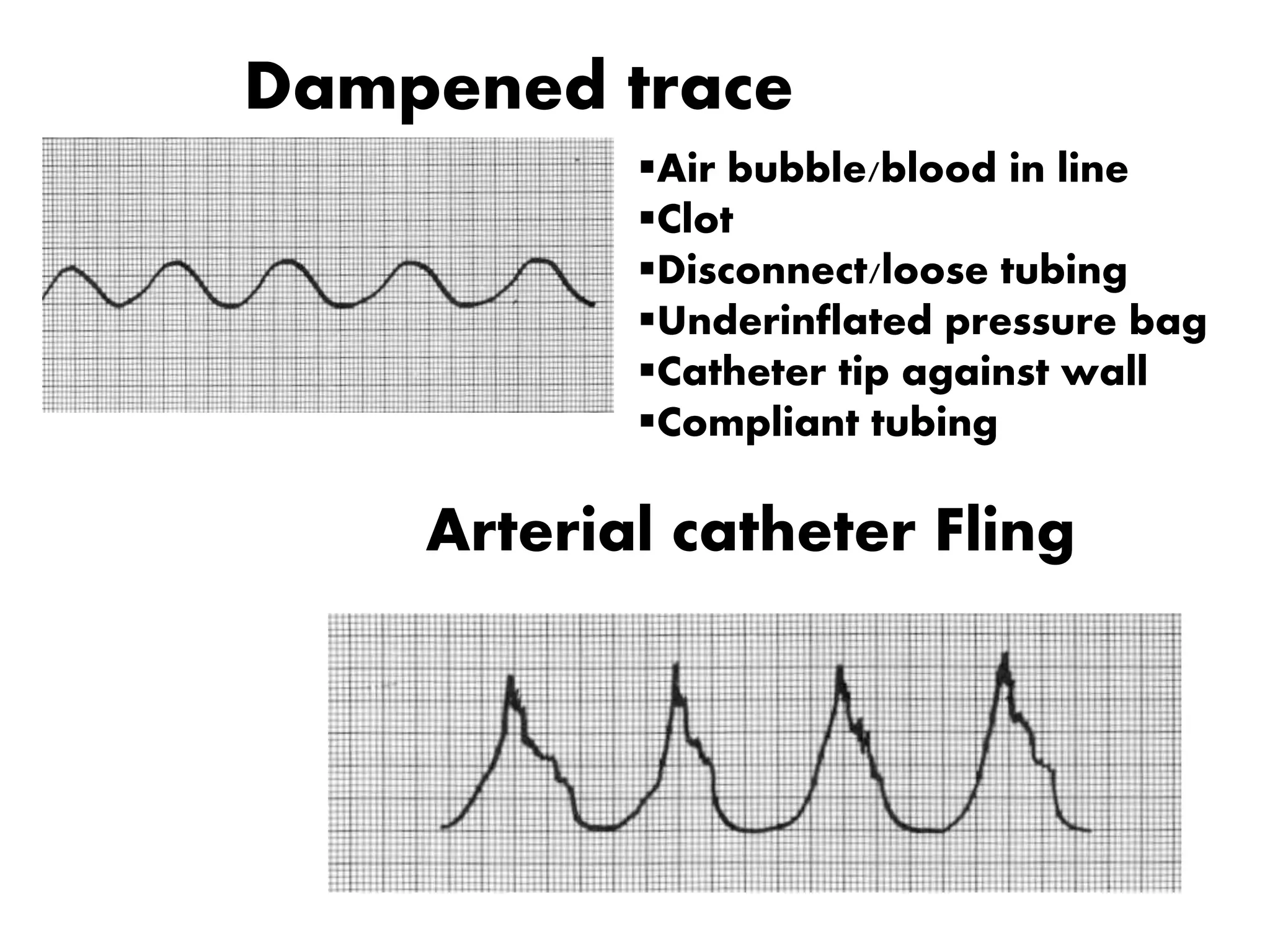 Dampened trace
Arterial catheter Fling
Air bubble/blood in line
Clot
Disconnect/loose tubing
Underinflated pressure bag
Catheter tip against wall
Compliant tubing
 
