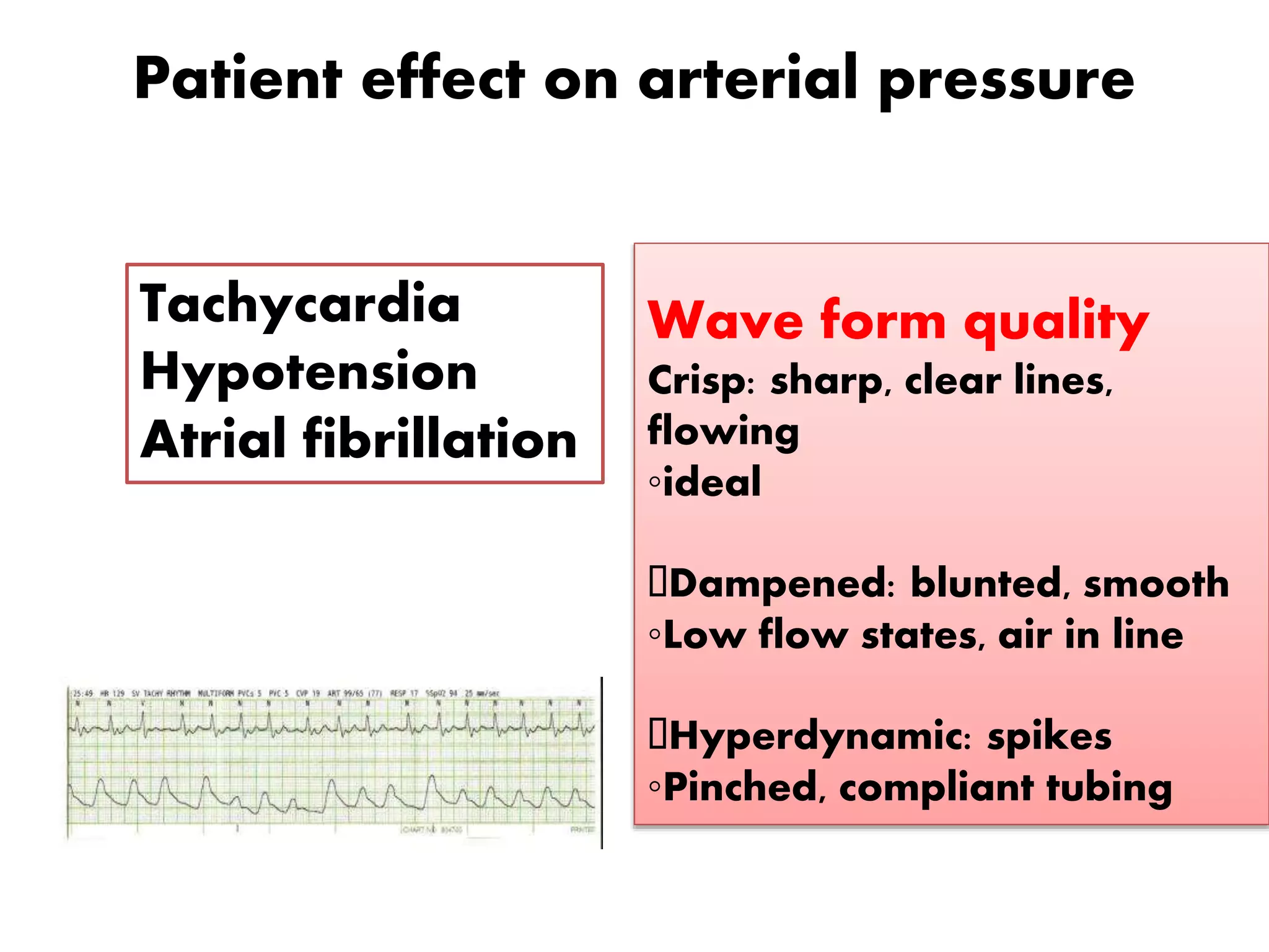 Patient effect on arterial pressure
Tachycardia
Hypotension
Atrial fibrillation
Wave form quality
Crisp: sharp, clear lines,
flowing
◦ideal
Dampened: blunted, smooth
◦Low flow states, air in line
Hyperdynamic: spikes
◦Pinched, compliant tubing
 