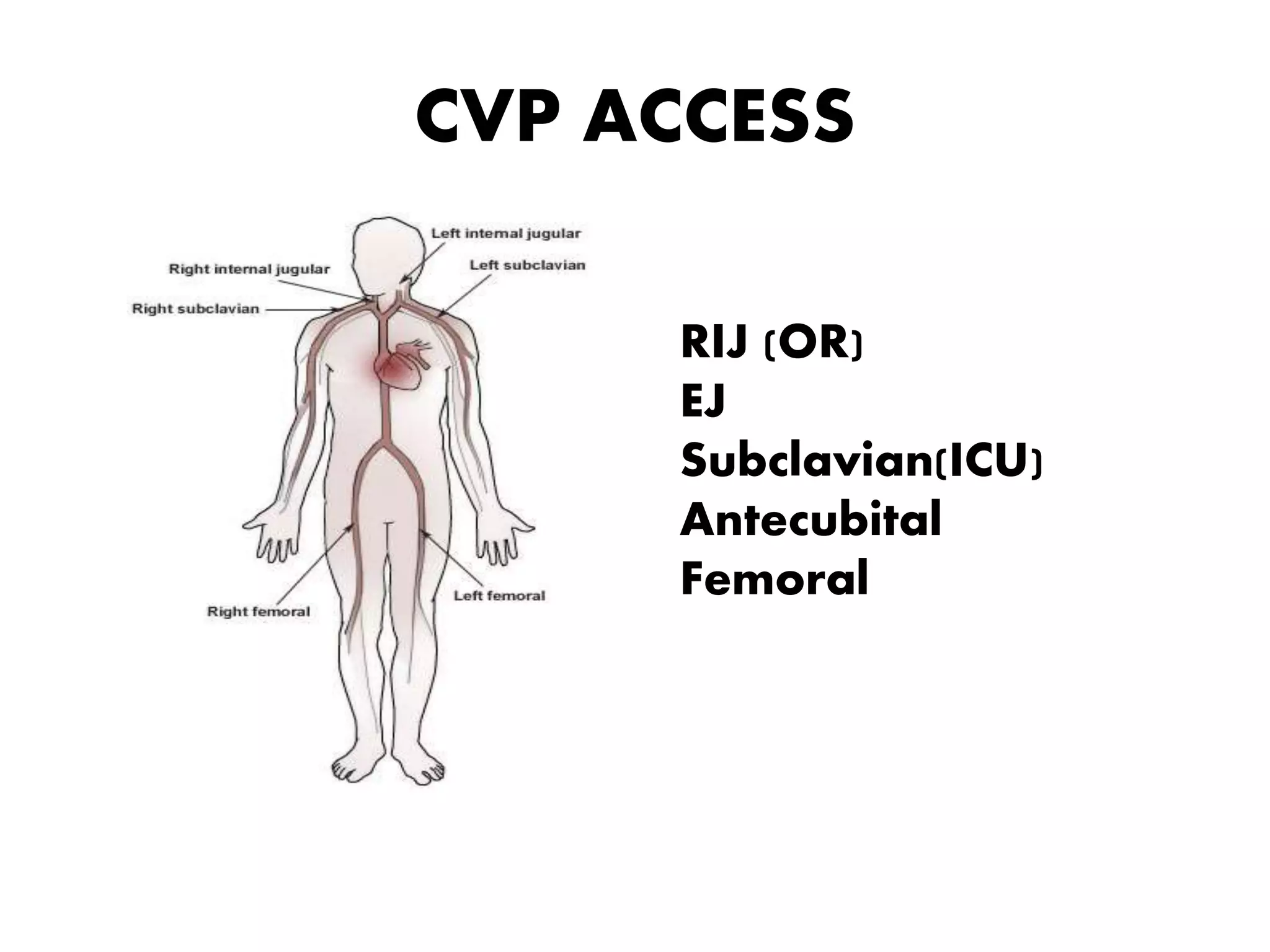 CVP ACCESS
RIJ (OR)
EJ
Subclavian(ICU)
Antecubital
Femoral
 