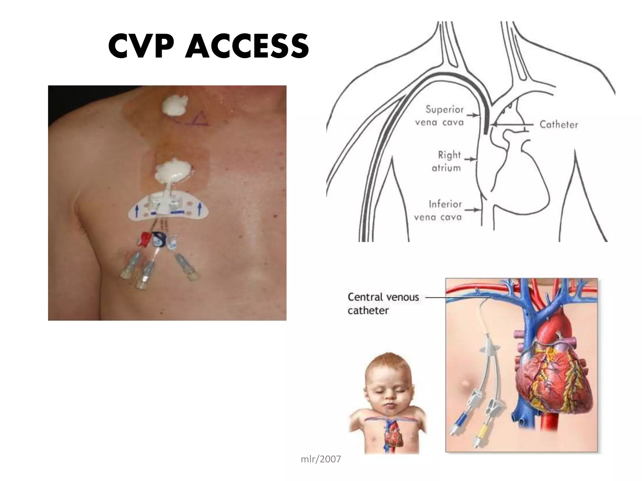 mlr/2007
CVP ACCESS
 